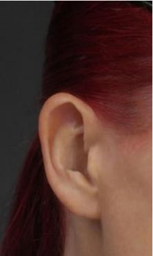 Cirurgia para reparar buracos e rasgos nas orelhas