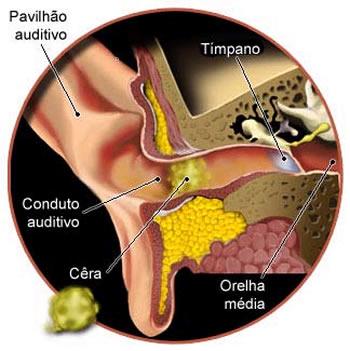 Cera protege e lubrifica canal auditivo