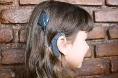Ouvido biônico é indicado para surdez severa 
